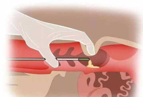 南京代孕哪家好,45岁多囊卵巢综合征，在深圳北大医院做试管成功率是多少？